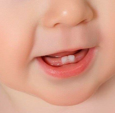 Прорезывание зубов у детей: симптомы и осложнения