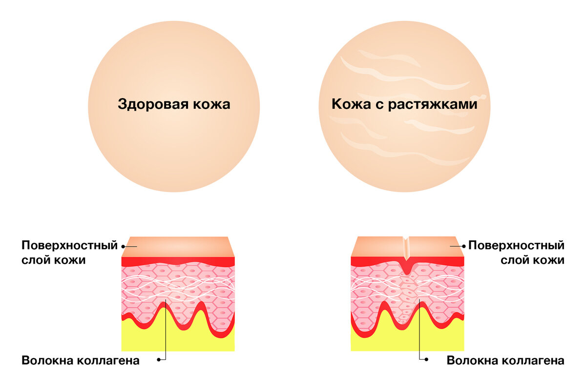Как появляются растяжки на коже