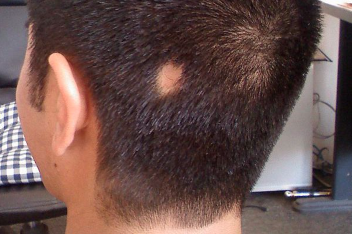 Мацл. Гнёздная (очаговая алопеция). Очаговая алопеция (alopecia Areata). Трихофития (стригущий лишай). Гнездная алопеция офиазис