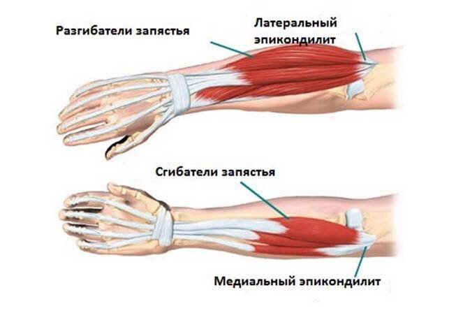 Лечение повреждений связок локтевого сустава