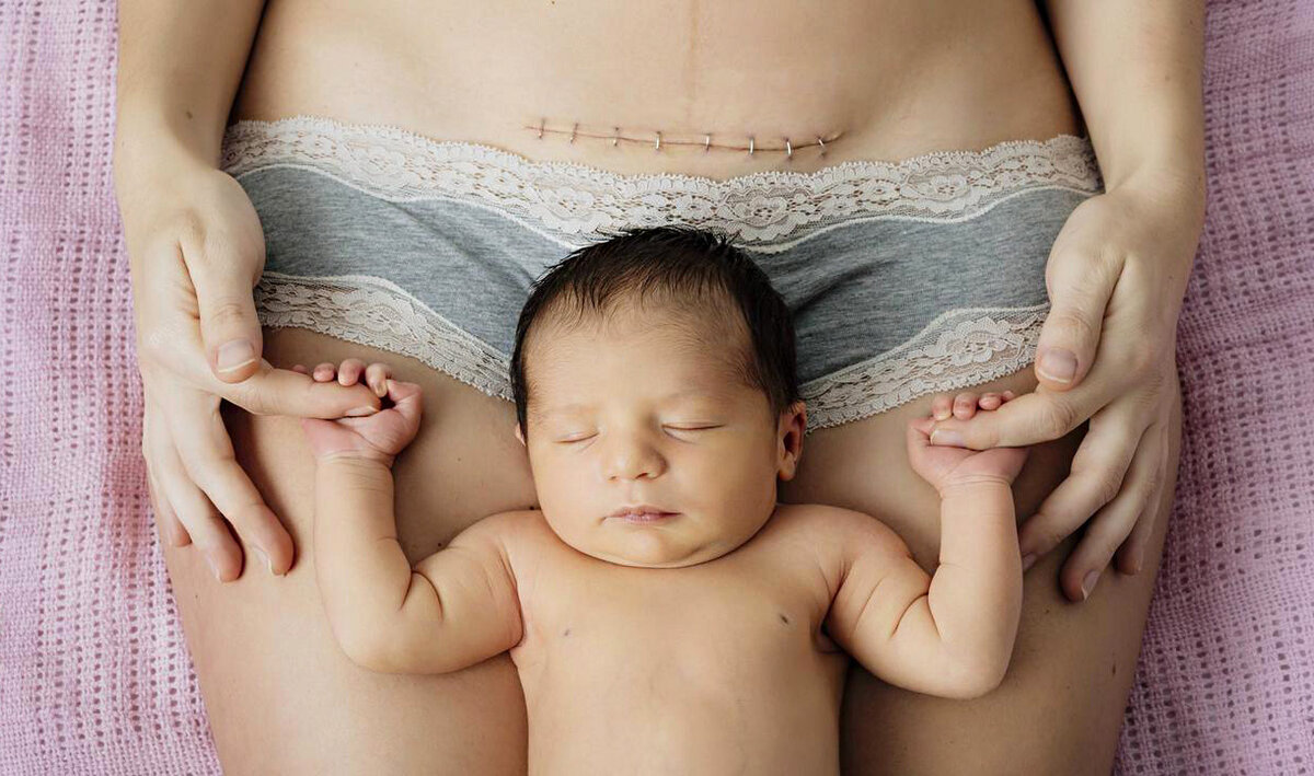 Кесарево сечение в США