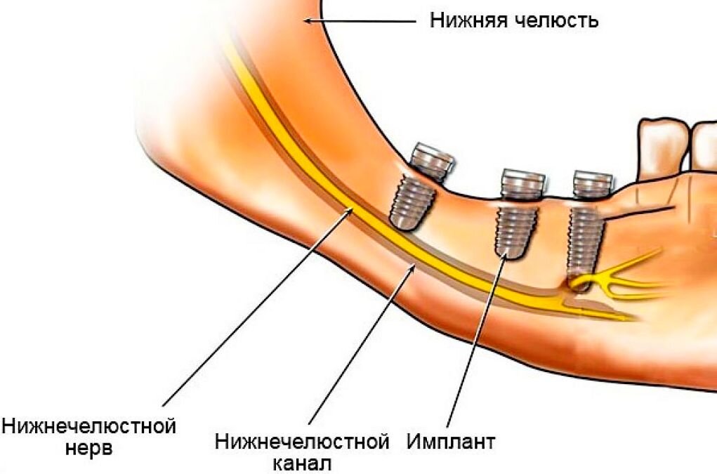 Осложнения после установки импланта