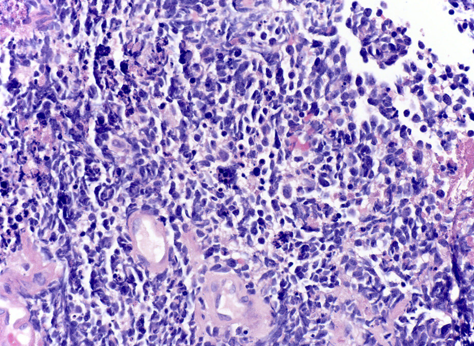 Мелкоклеточный рак легкого. Histological classification of lung Cancer.