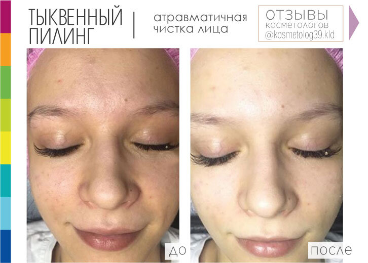 ДО процедуры: расширенные поры, комедоны, жирный блеск кожи, нарушения пигментации...