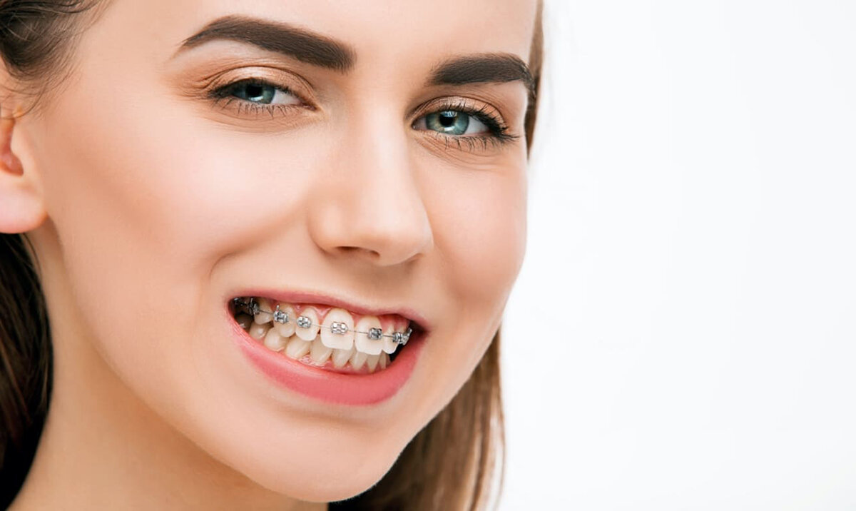 В каких случаях ставят брекеты на одну челюсть? Почему это может быть ...