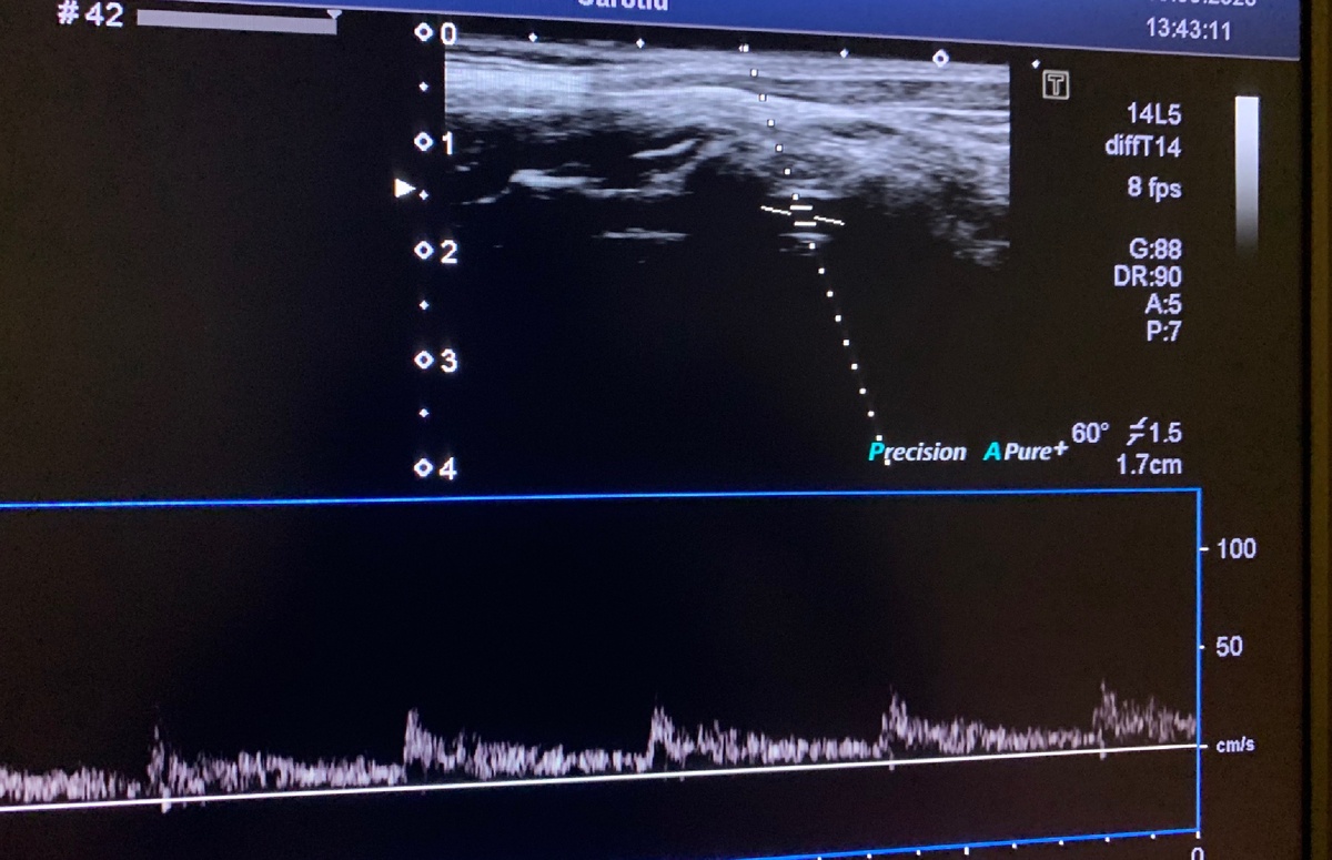 Нормальные показатели кровотока в позвоночной артерии 