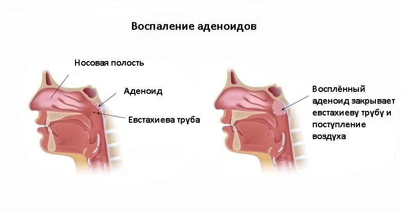 аденоиды механизм развития, аденоиды почему появились