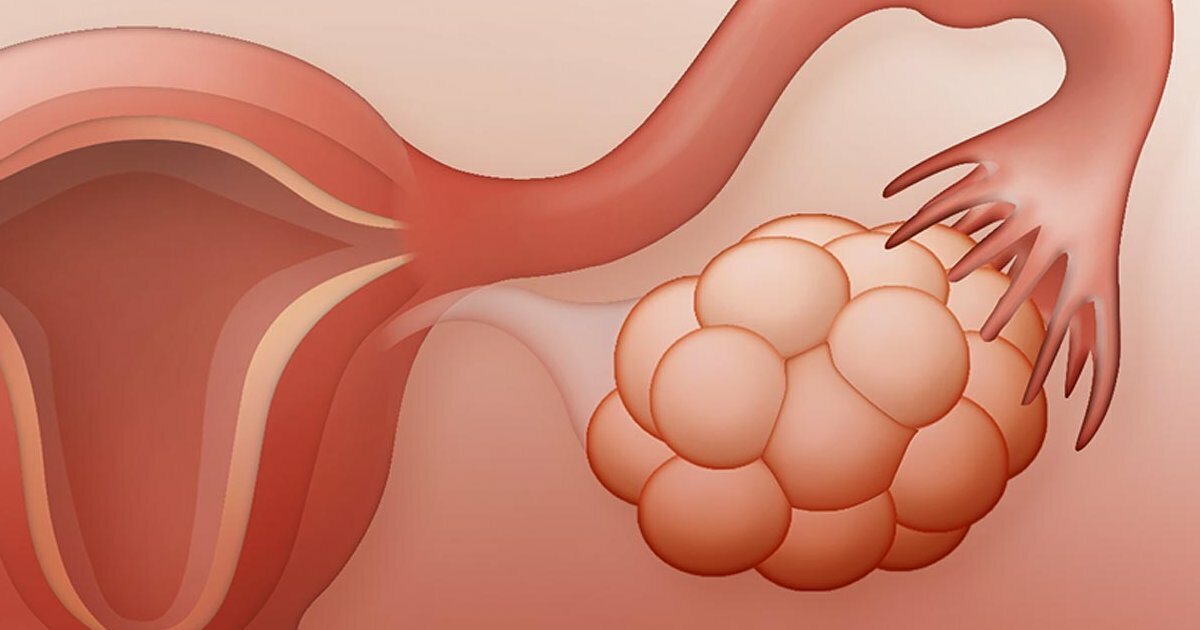 Поликистоз яичников что. Гипоплазия матки и поликистоз яичников. Синдром Штейна-Левенталя (поликистоз яичников). Врожденные аномалии яичников. Пороки развития яичников.