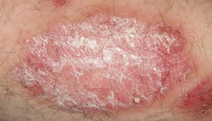 Очаг псориаза