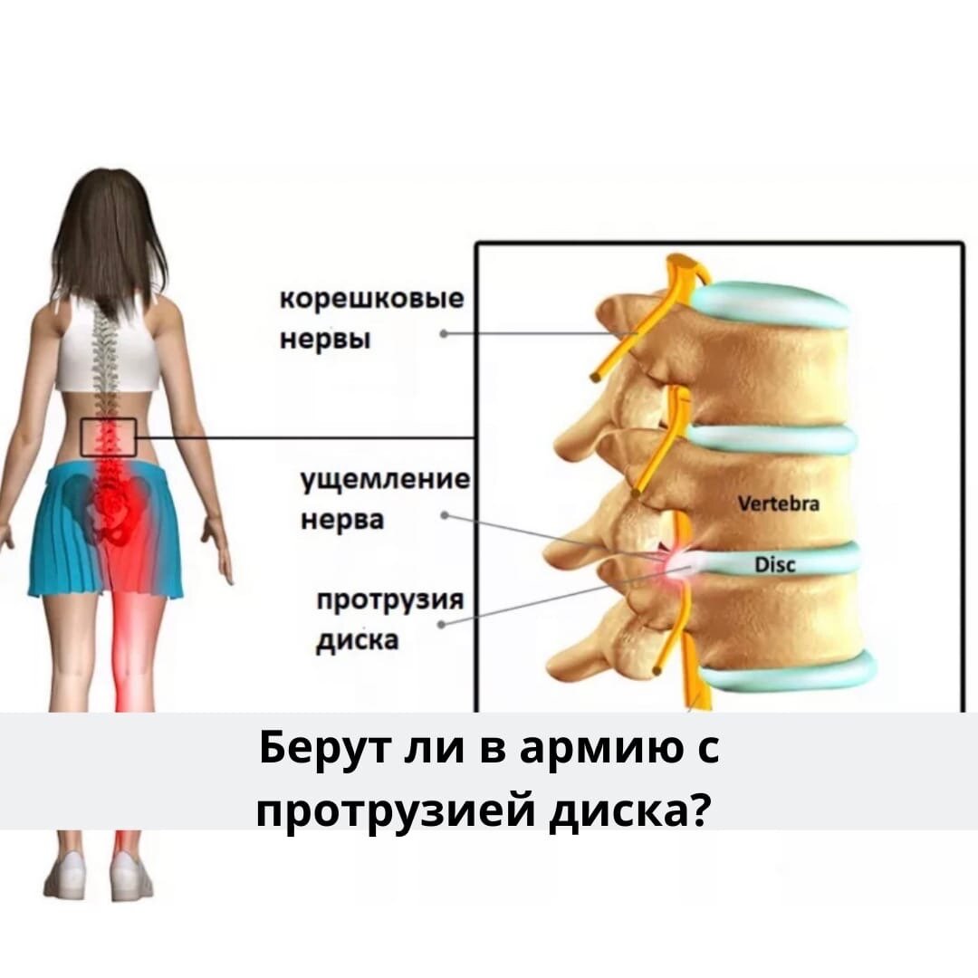 Берут ли в армию с больной спиной? Топ-7 болезней спины