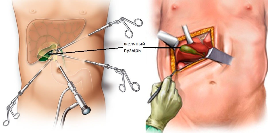 Холецистэктомия желчного пузыря лапароскопическая. Лапароскопия желчного шрамы. Холецистит и лапароскопическая холецистэктомия. Лапаротомия аппендикса.