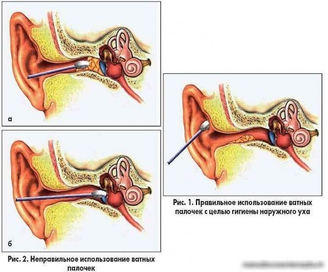 Удаление ушных серных пробок