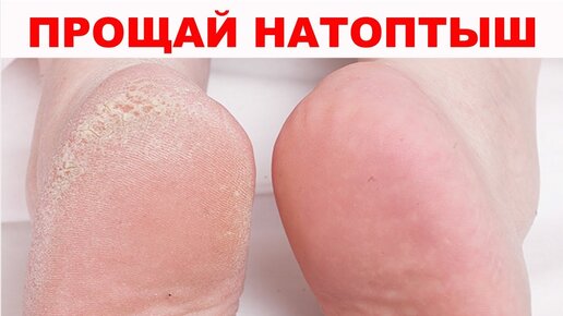 Натоптыши, сухие мозоли, трещины на пятках не дают покоя. 5 СУПЕР СПОСОБОВ гарантированно помогут