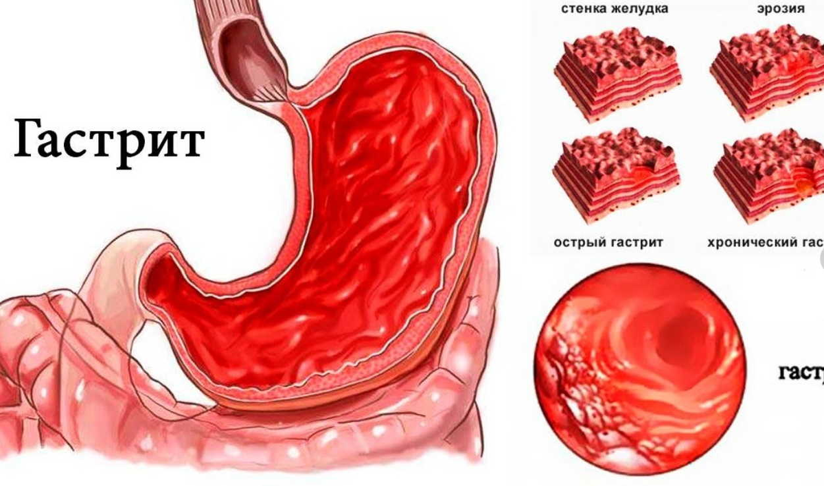 Гастрит: что это, симптомы, виды, причины возникновения, как лечить и сколько это стоит