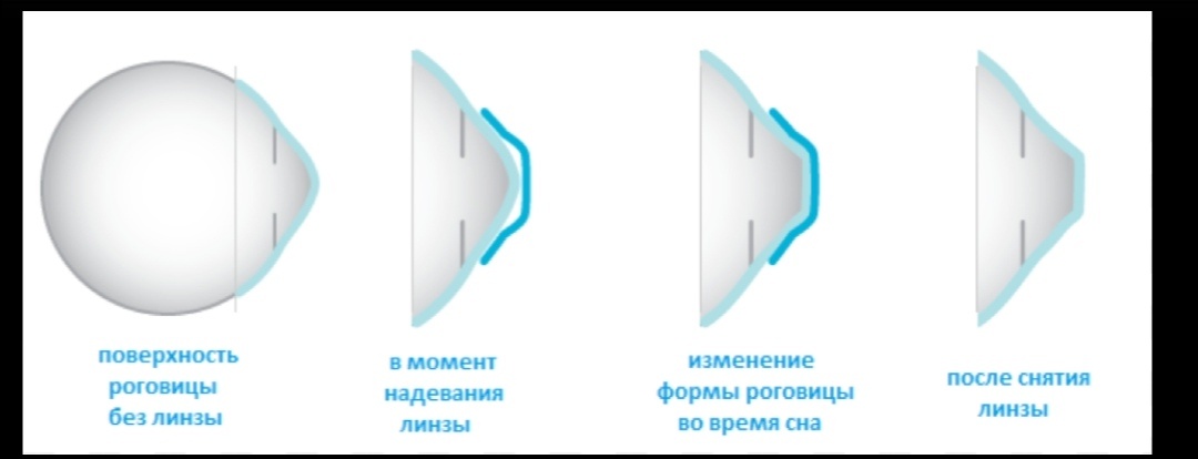 Ночные линзы 