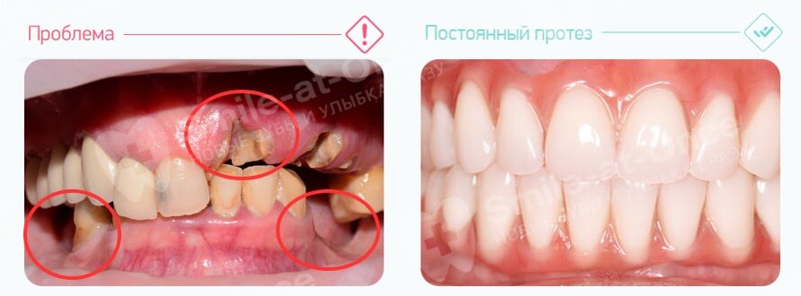 Уровень собственной десны может быть с большими перепадами из-за разрушения и долгого отсутствия зубов, хронического воспаления тканей и атрофии челюстной кости. Протез с искусственной десной скрывает эти недостатки. Фото: Smile-at-Once.ru.