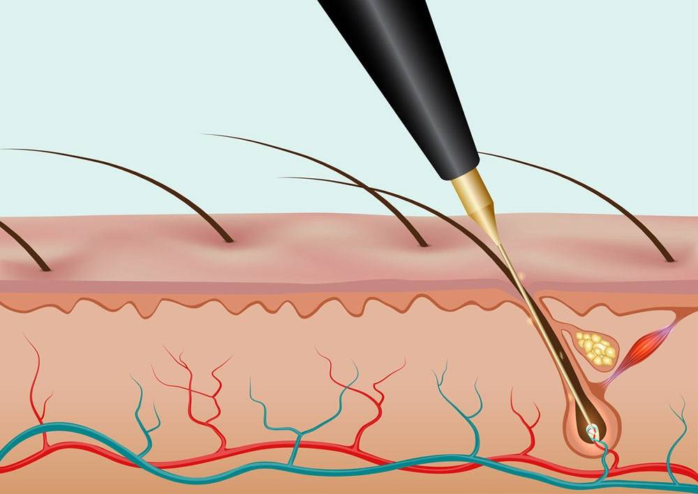 Как выдергивать волосы воском. Волосяной фолликул на электроэпиляции. Электролиз и термолиз электроэпиляция. Флеш термолиз электроэпиляция. Электроэпиляция игла в фолликуле.
