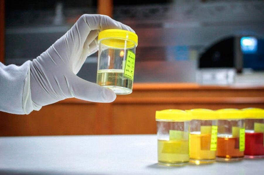 Самый очевидный признак РМП – примесь крови в моче (гематурия)