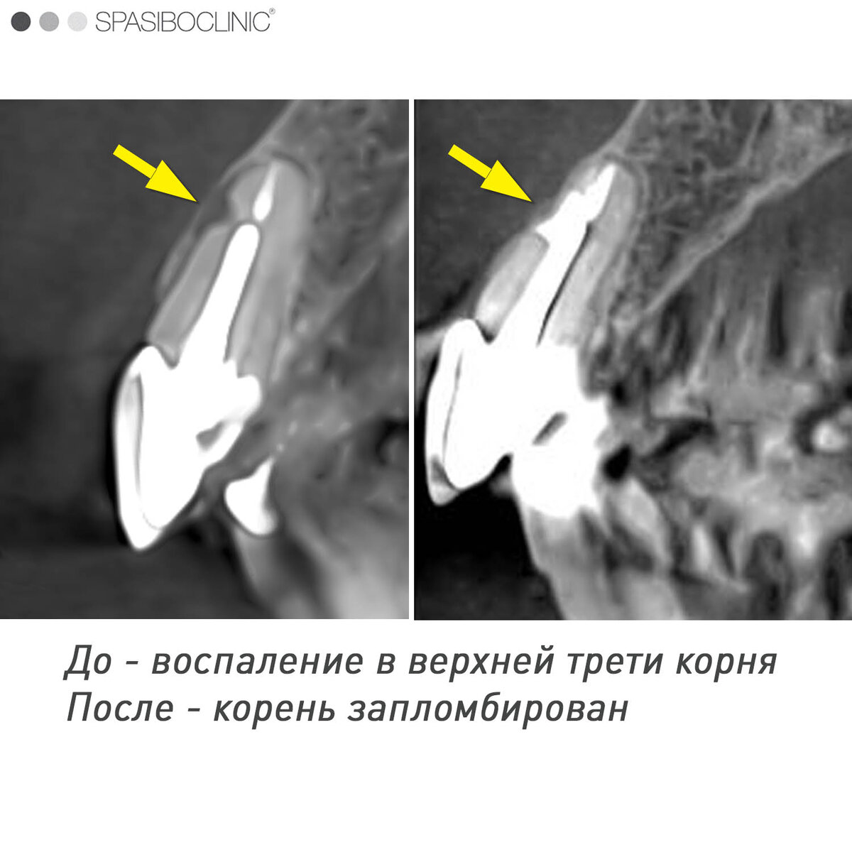 При воспалении зуба уходит кость. Как выглядит на снимке плохо запломбированный зуб.