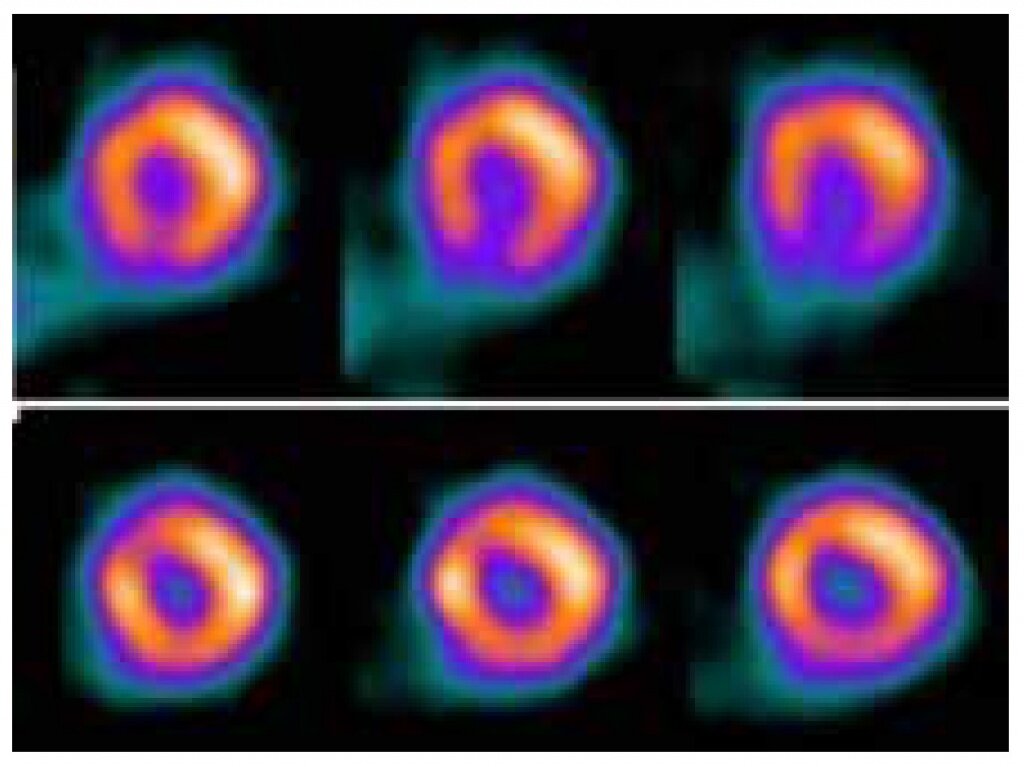 Спустя пятнадцать минут после ужина сердце пациента не полностью снабжается кровью (вверху), таллий распределен неравномерно, а через три часа все приходит в норму (Nozomu Kaneko e. a. «Journal of Cardiology Cases» 2013, 8)