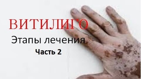 Витилиго. Этапы лечения (часть 2)