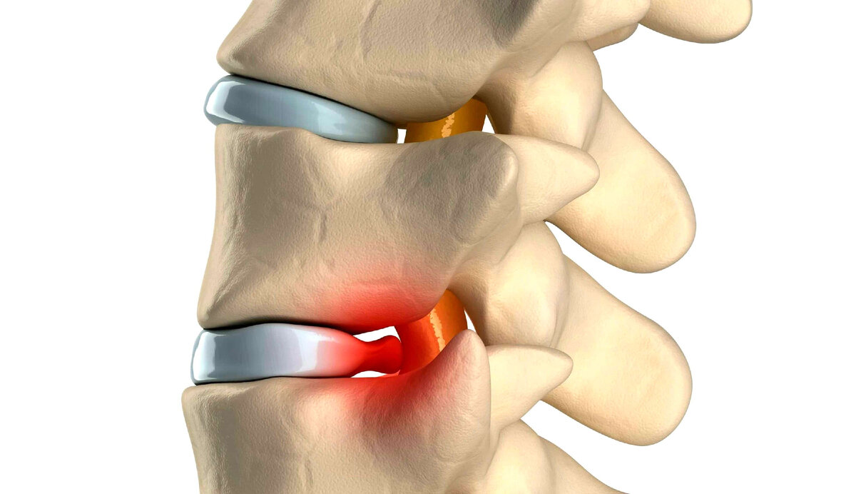 Межпозвоночная грыжа может длительное время не беспокоить пациента