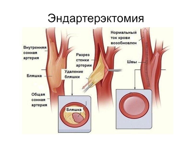 Операция на сонной. Трансаортальная эндартерэктомия. Эверсионная каротидная эндартерэктомия ход операции. Эндартерэктомия нижних конечностей техника. Классическая каротидная эндартерэктомия.