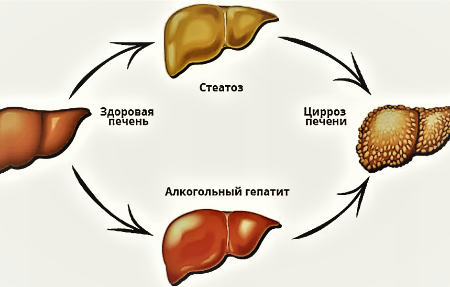 Алкогольный гепатит презентация