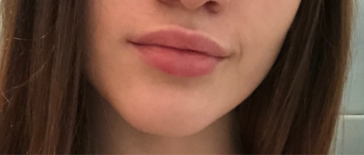 После первой процедуры 1мл