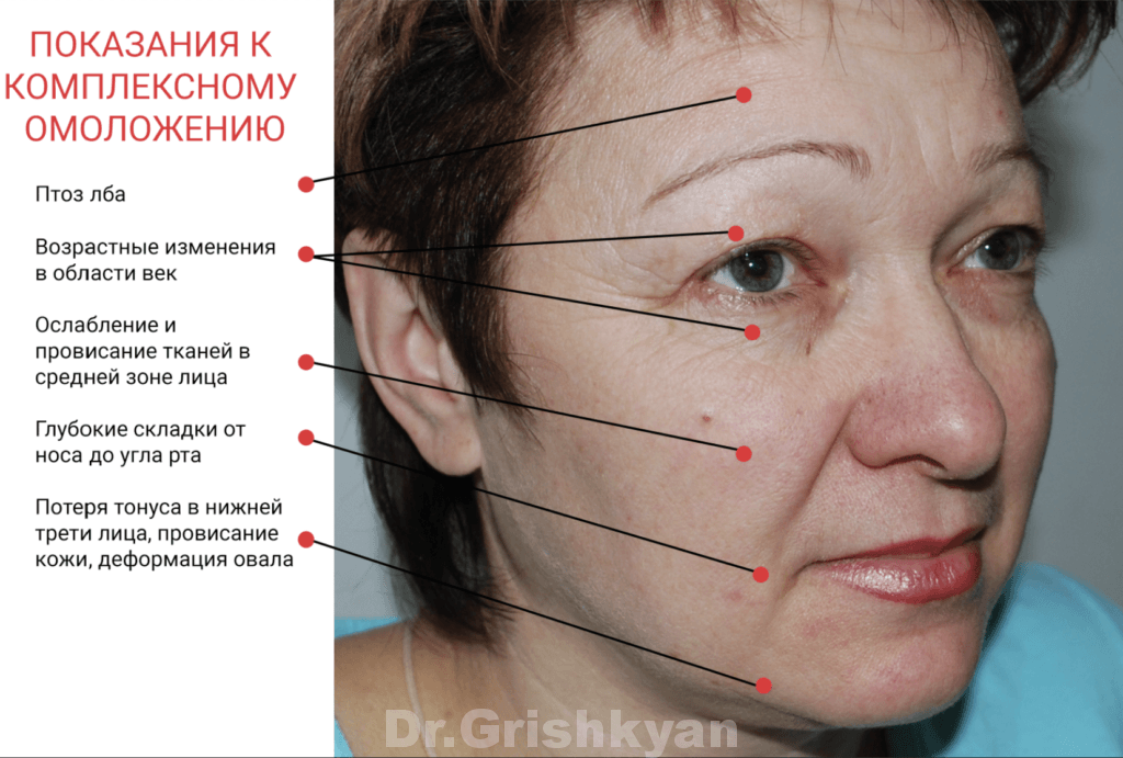 Показания к комплексному омоложению лица видно невооруженным глазом: старение век, провисание средней зоны и потеря  овала лица. 