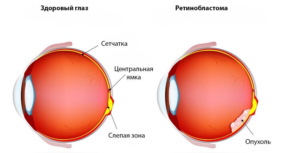 Рак сетчатки глаза (ретинобластома): симптомы, диагностика, лечение