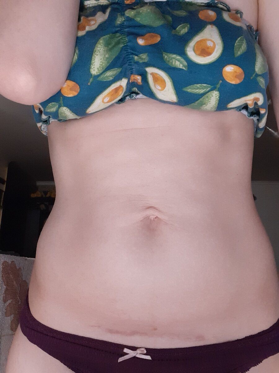 Мой шов после 2-х операций 