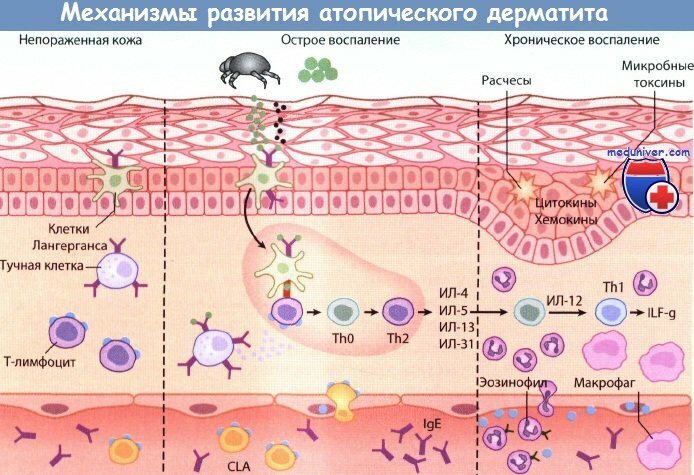 Механизмы развития атопического дерматита