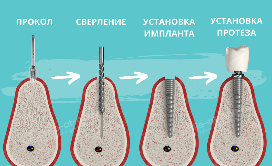 Смысл бескровной имплантации зубов – на нашей инфографике. Фото: Smile-at-Once.ru.