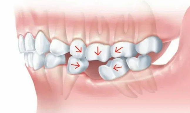 Зубы в два ряда