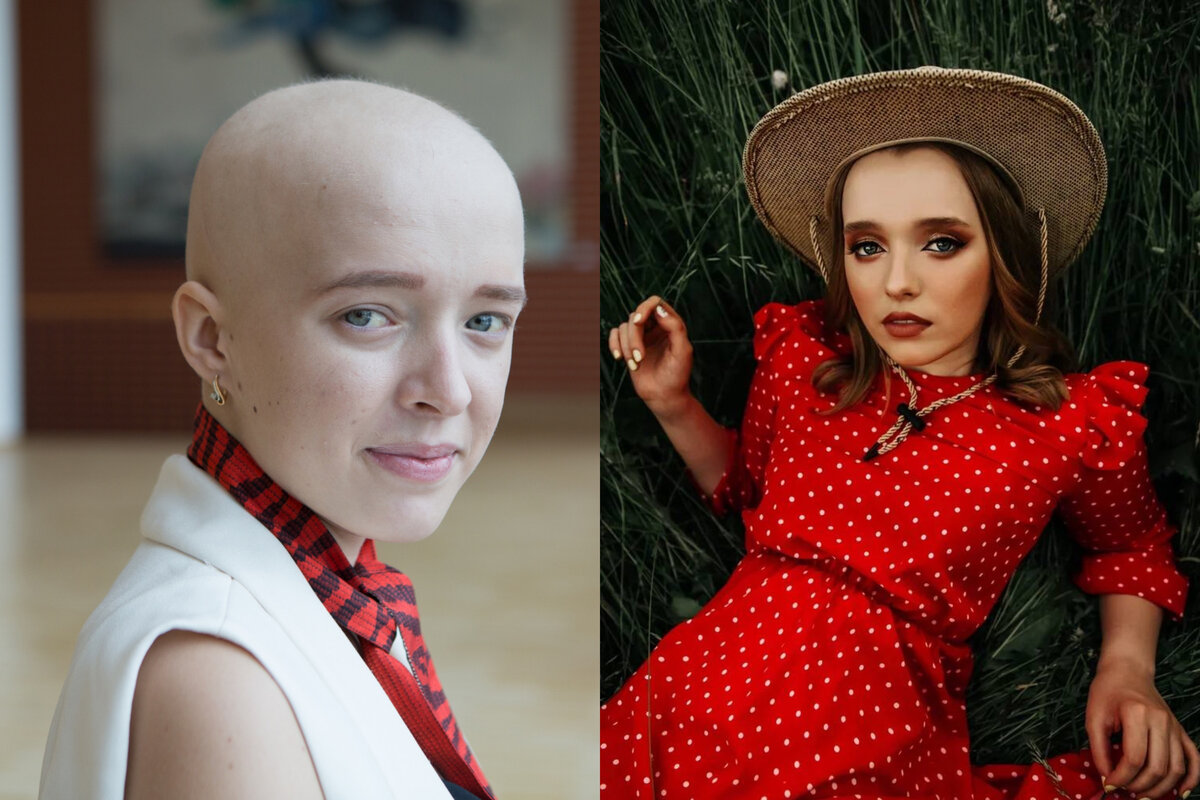 Полина во время лечения от апластической анемии и сейчас