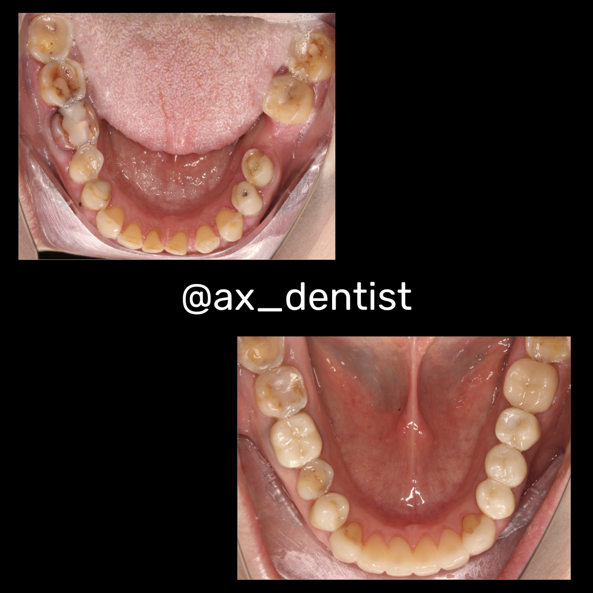 Пример имплантации в шашек клинике