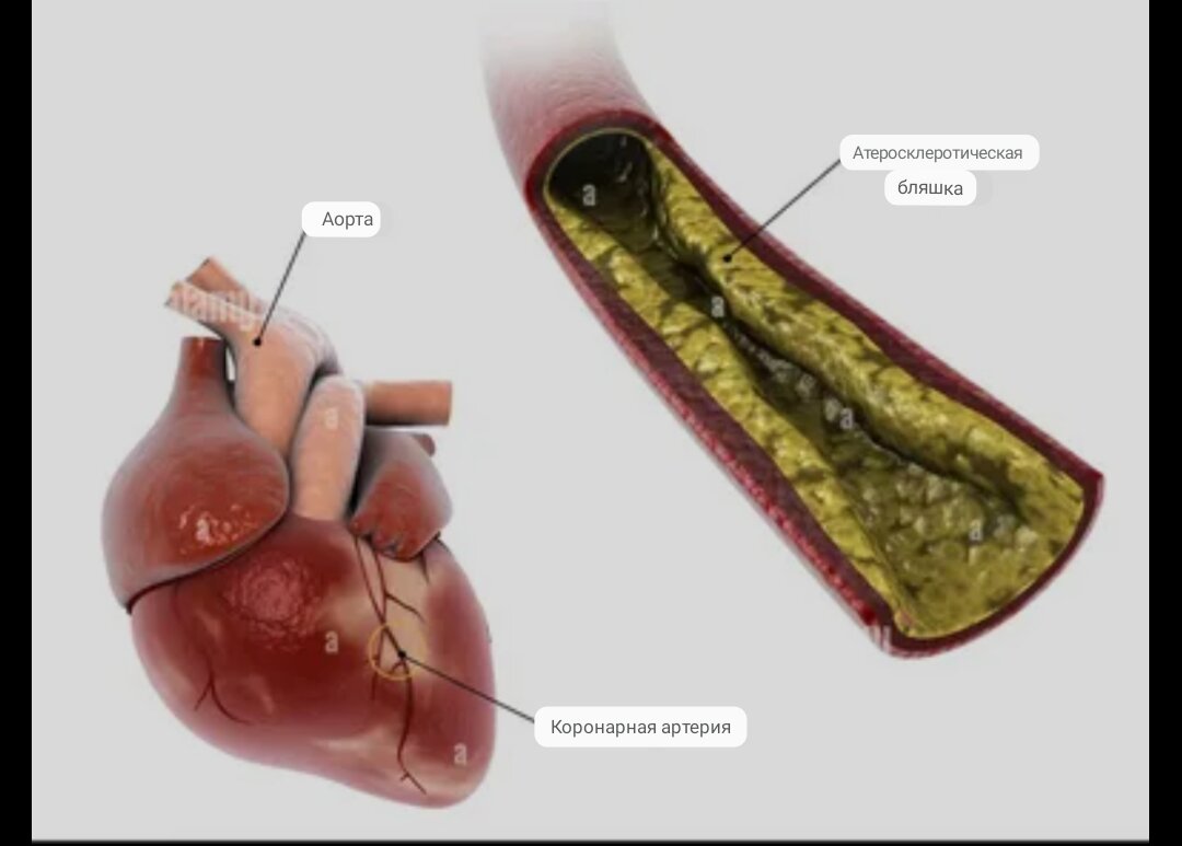 При поражении атеросклерозом артерий сердца кровоток через них значительно затрудняется, что может вызвать инфаркт