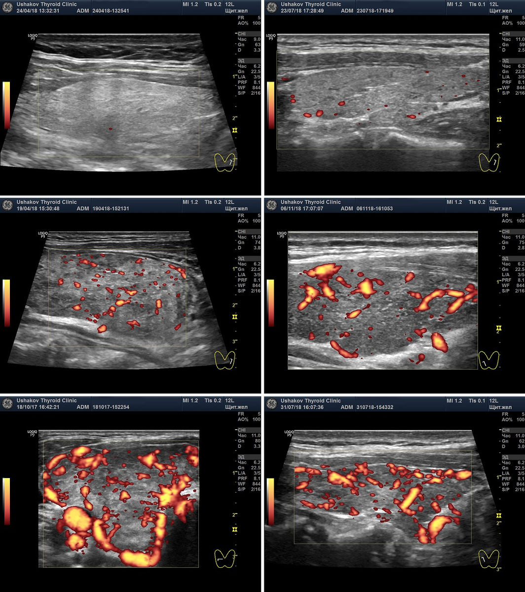 Варианты кровотока в щитовидной железе при допплерографии в режиме ЭДК (энергетическое допплеровское картирование)