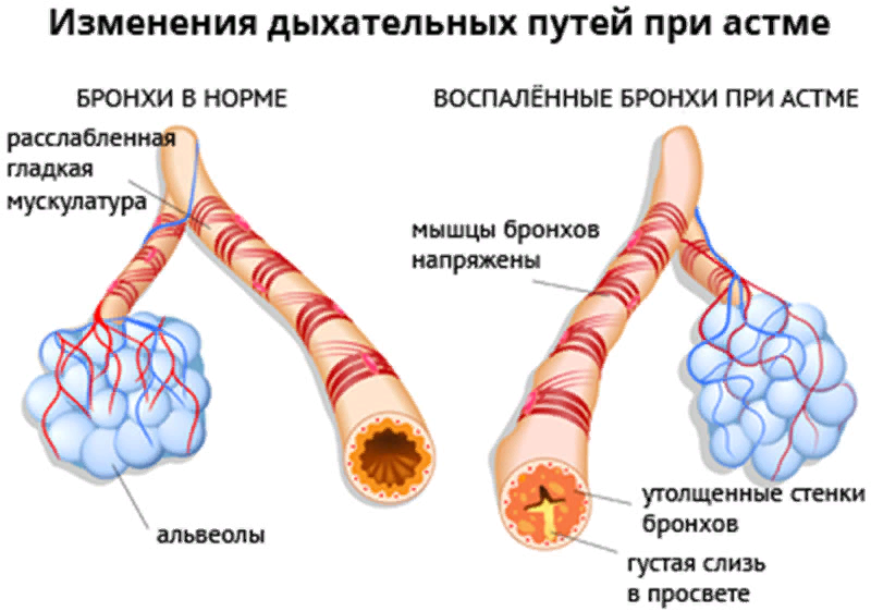 Изменение бронхов при бронхиальной астме. Альвеолы при астме. Бронхиальная астма отек легких