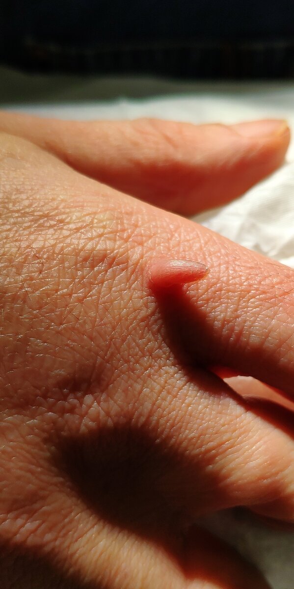 Кожный рог. Причиной этого образования на коже может быть ВПЧ, поражающий кожу