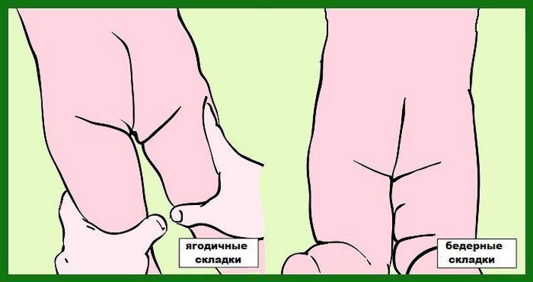 Перианальные складки у ребенка где. Дисплазия тазобедренных суставов складки. Шпатель для соскоба на энтеробиоз. Перианальные складки у ребенка где. Перианальные складки у ребенка где.