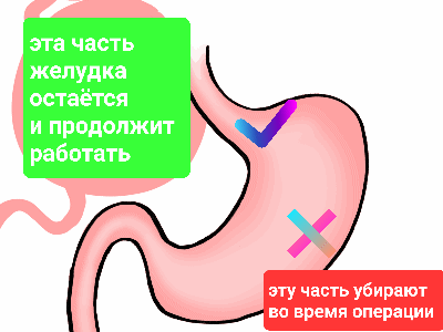 Что происходит с желудуом во время операции Sleeve (вертикальной гастрэктомии)