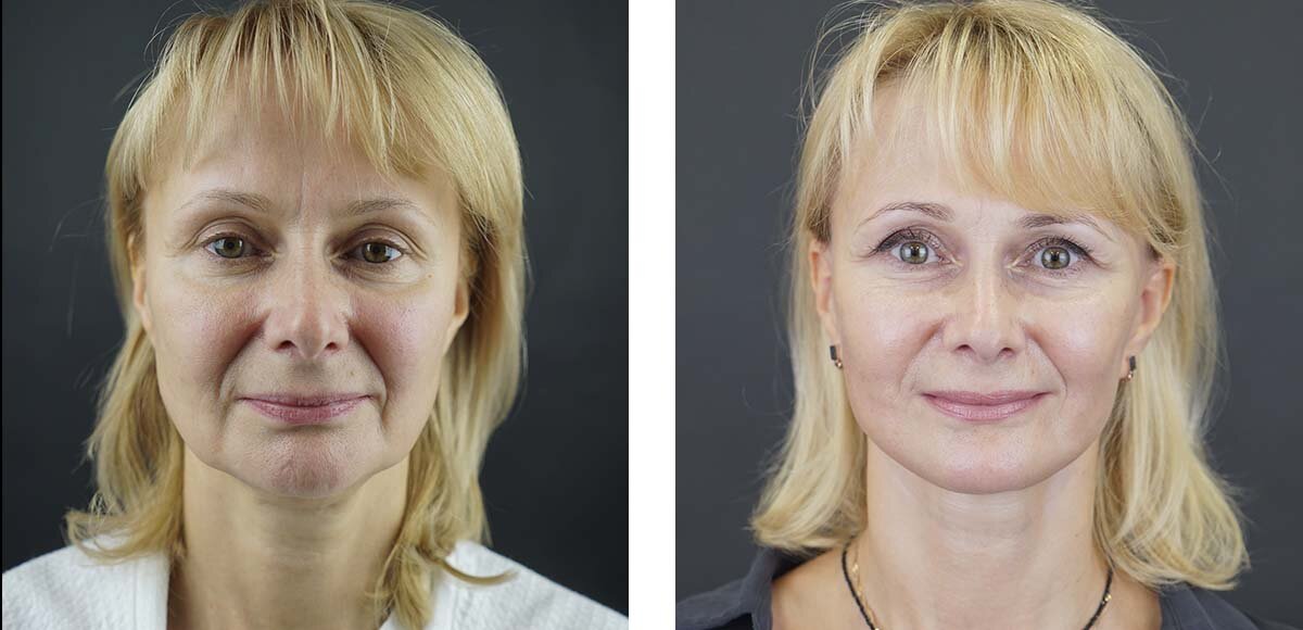 Осторожность при выборе нескольких процедур