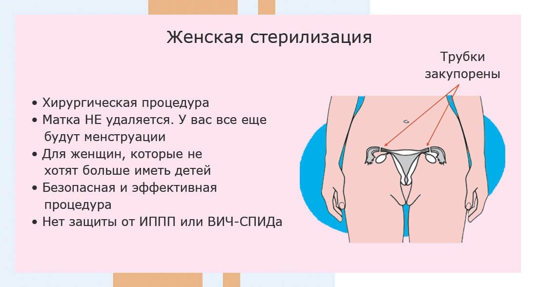 мужская и женская стерилизация плюсы и минусы. хирургический метод контрацепции. добровольная хирургическая стерилизация. стерилизация труб у женщин. добровольная хирургическая контрацепция (стерилизация).