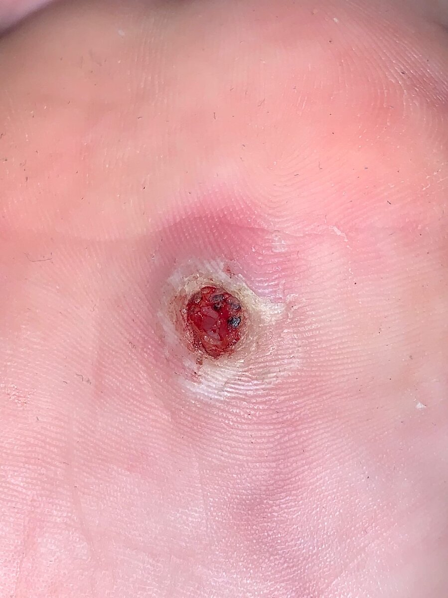 Бородавка на ступне после удаления верхнего слоя.