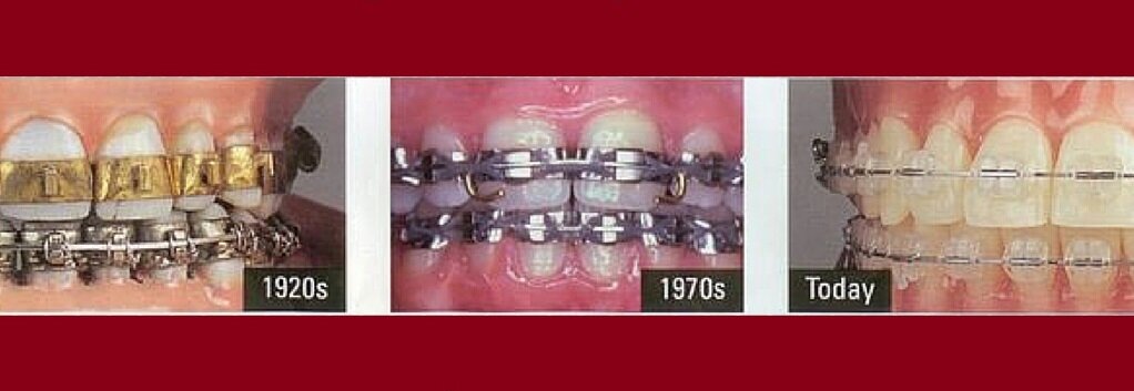 Изменение эстетики брекетов за последние 100 лет