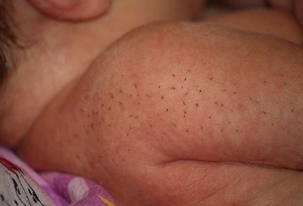 Щетинка у новорожденных