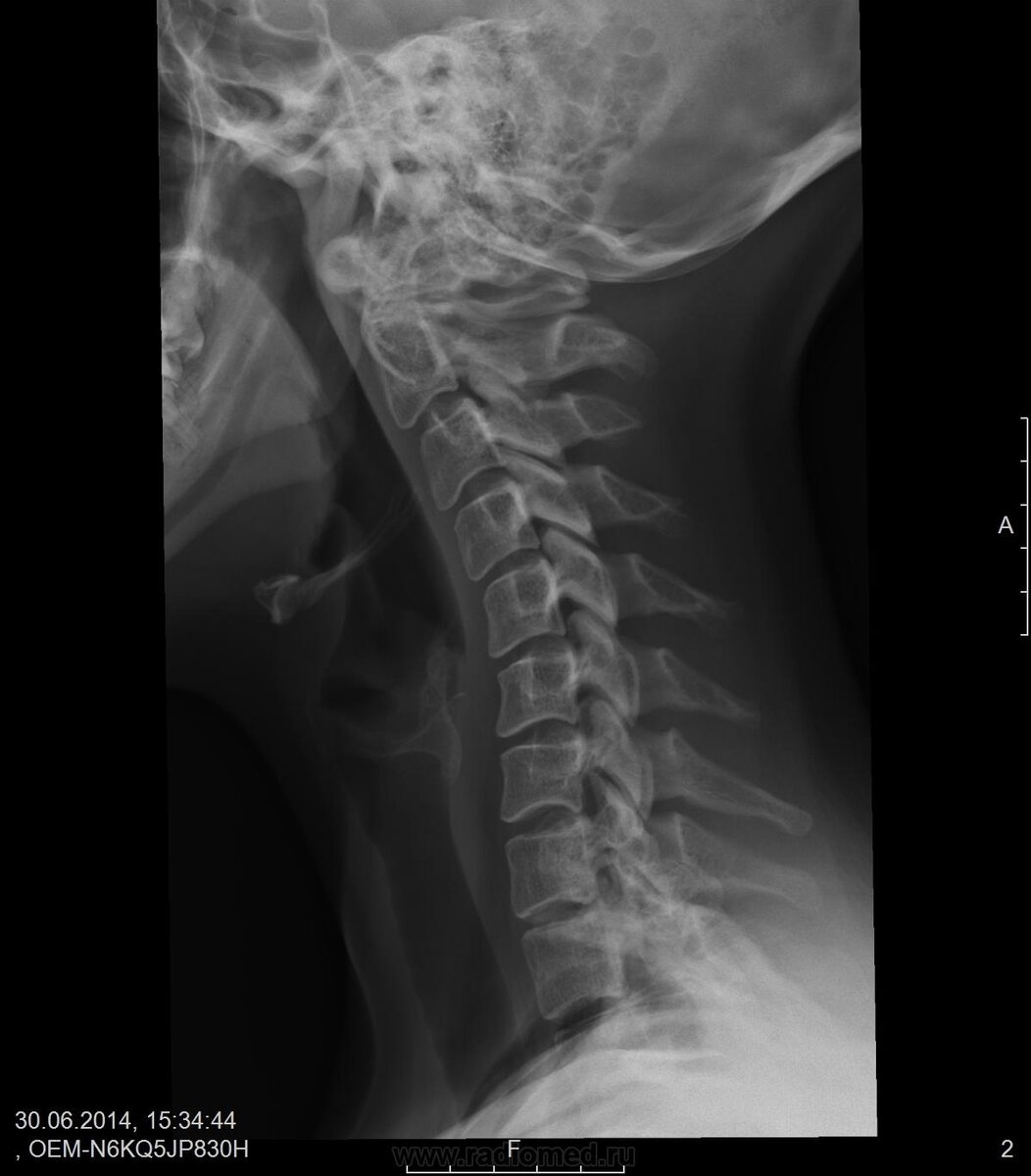 Шейный отдел позвоночника рентген. Кифоз шейного отдела позвоночника. Кифоз с5-6 шейного позвонка.