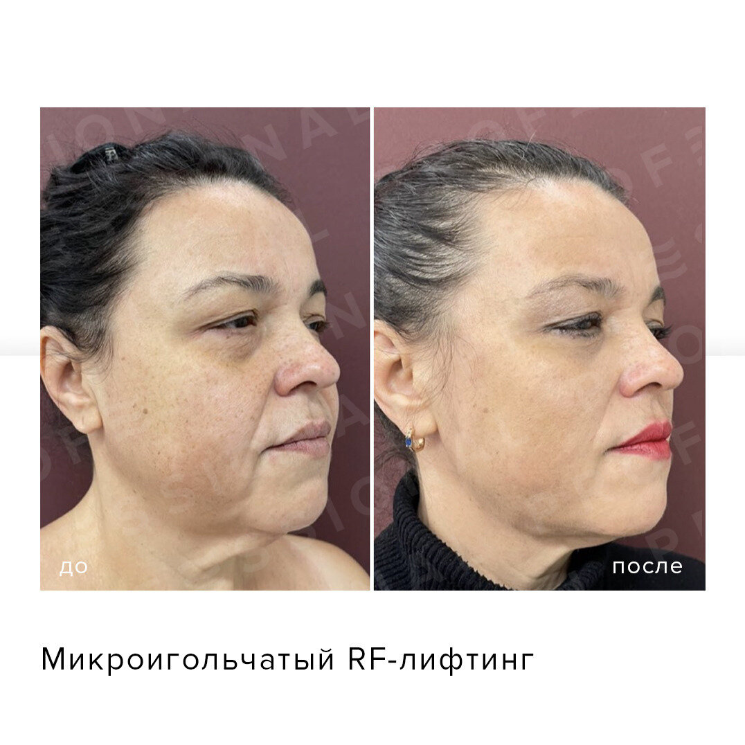 ИМЕЮТСЯ ПРОТИВОПОКАЗАНИЯ, НЕОБХОДИМА КОНСУЛЬТАЦИЯ СПЕЦИАЛИСТА
